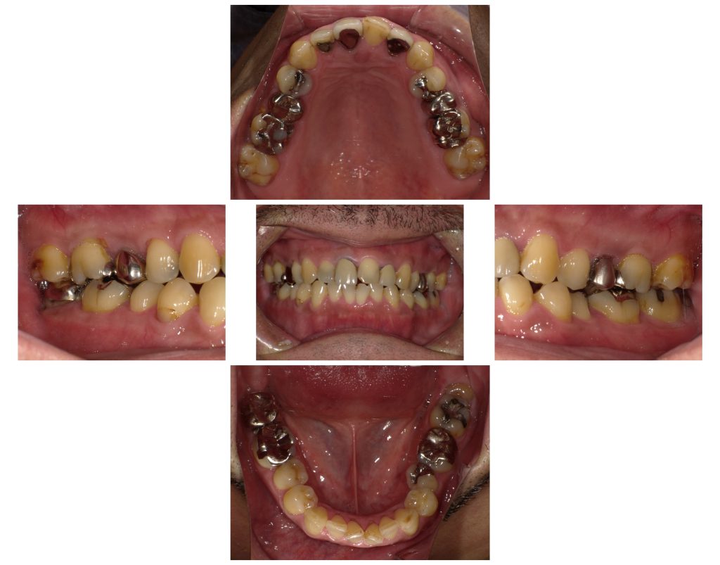 60代男性「前歯にひびが入っている」あごの動きを確認する「咬合診断」を行い、摩擦に強く耐久性がある「ジルコニアクラウン」で歯を保護する噛み合わせに改善した症例