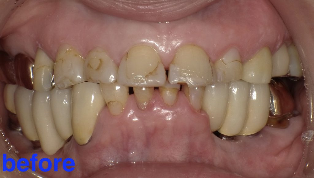 70代女性「綺麗な歯でしっかり噛めるようになりたい」歯に負担がかかる低い噛み合わせを、自然な白さで適合もよい「ジルコニアセラミック」を用いて総合的に治療し、見た目も美しく改善した症例