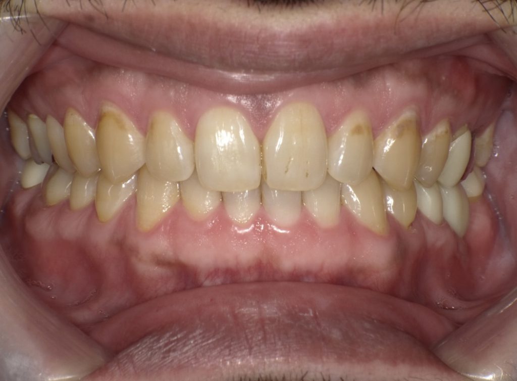 40代男性「着色した歯を白く綺麗にしたい」全体的な歯の黄ばみや色ムラを、歯科医院で薬剤を使用して歯を白くする「オフィスホワイトニング」で改善させ、明るい口元にした症例