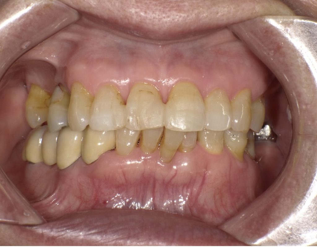 80代女性 部分入れ歯の修理と「ジルコニア」の被せ物で上の歯の噛み合わせを改善した症例