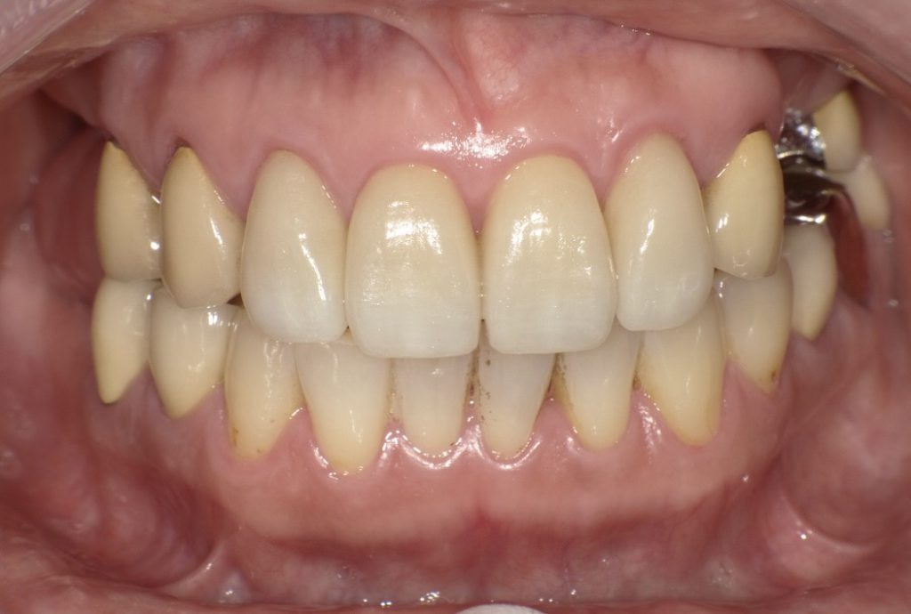 60代女性 欠損部位を「コーヌス義歯」で補いしっかり噛めるようにした症例