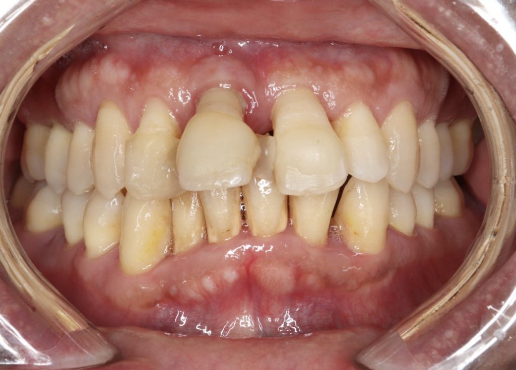 40代男性「前歯が揺れている。見た目が気になり笑えない」歯を支える組織に炎症が起こる重度の「若年性歯周病」を改善させ、自然な見た目の「ジルコニアクラウン」で美しい口元にした症例
