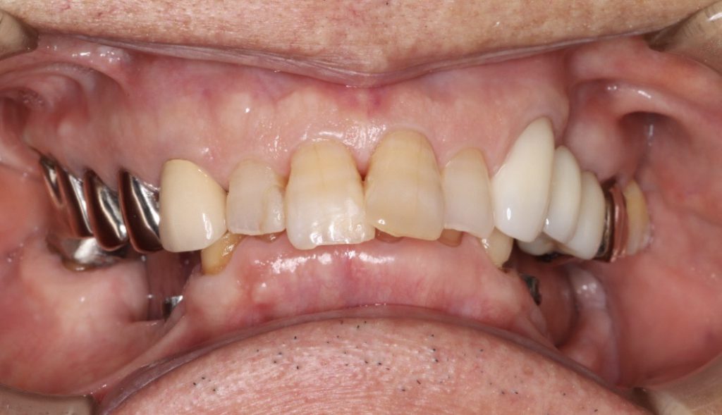 80代男性 破損した部分入れ歯を直す際に「ジルコニア」の被せ物治療を併用して全体の噛み合わせを改善した症例