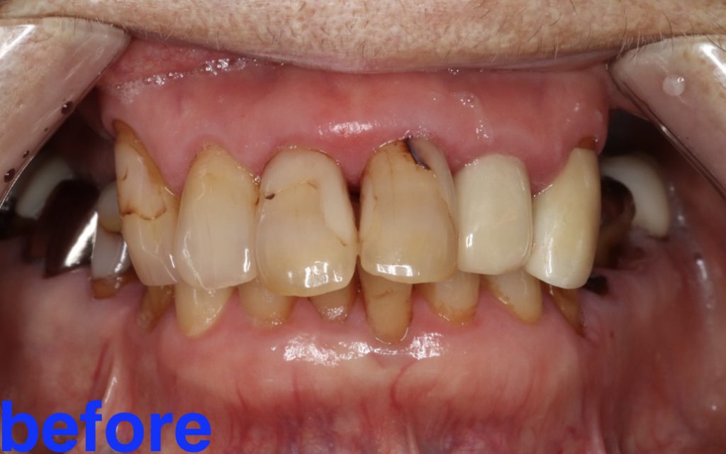 80代女性「よく噛めず、歯の見た目も気になる」加齢により低くなった噛み合わせを、白く適合の良い「ジルコニア」の被せ物と部分的な金属の入れ歯による全体的な治療で美しく改善させた症例