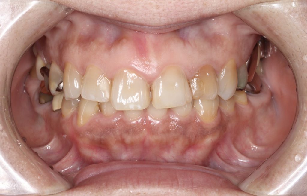 60代女性 ジルコニアの被せ物と金属の入れ歯を併用して噛み合わせを改善した症例