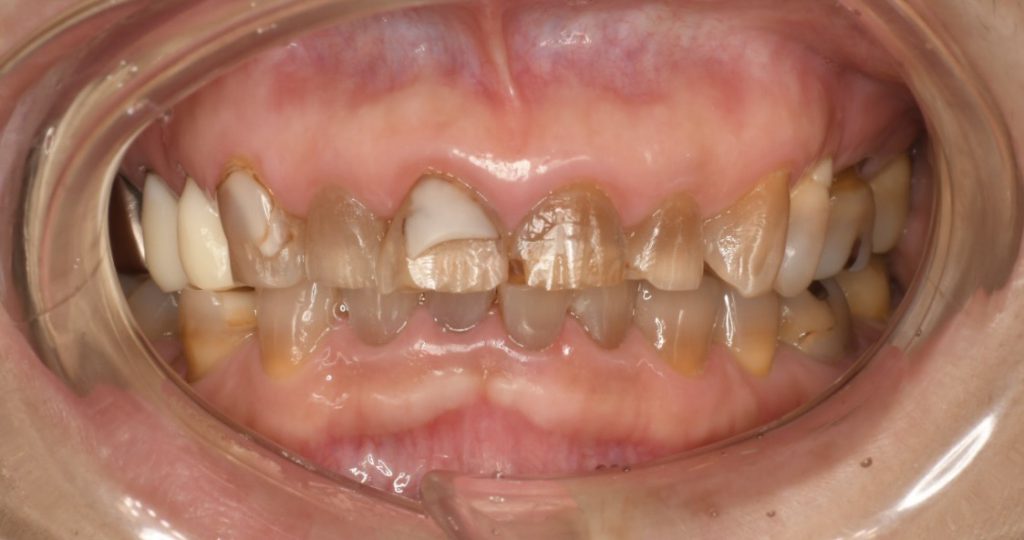 50代女性「熱い物がしみる時がある」歯のすり減りと抗生物質による変色「テトラサイクリン歯」を、白くて変色しにくい「ジルコニアクラウン」を入れて見た目と噛み合わせが改善し、しみなくなった症例