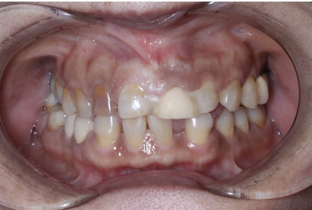 50代女性 上の歯全体の被せ物をやり直して噛み合わせと見た目を改善した症例