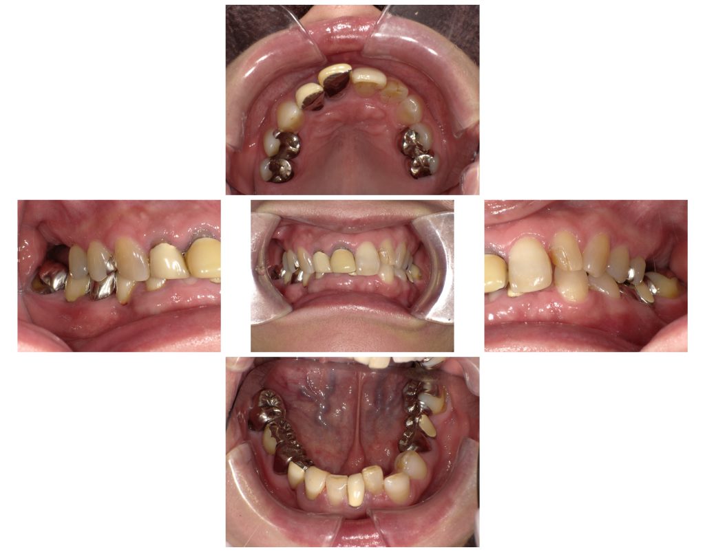 50代女性 奥歯の欠損で低くなった噛み合わせをジルコニアの「延長ブリッジ」や被せ物で改善した症例