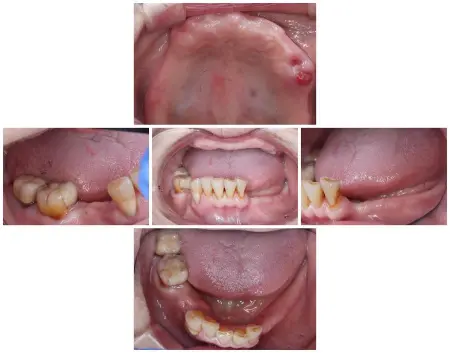80代女性 崩れた歯並びと噛み合わせを入れ歯で改善した症例