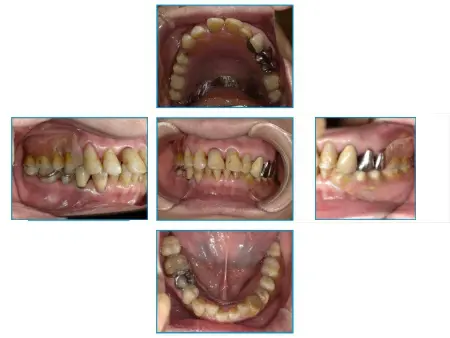 80代女性 崩れた歯並びと噛み合わせを入れ歯で改善した症例