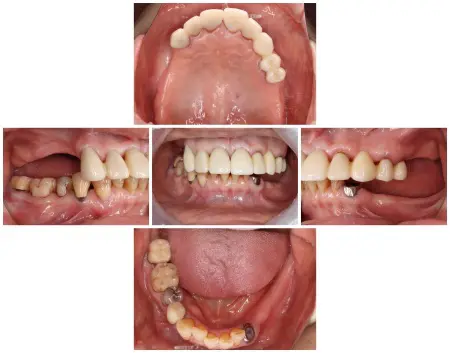 80代女性 崩れた歯並びと噛み合わせを入れ歯で改善した症例