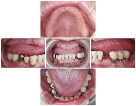 60代女性 温存が困難な歯を抜歯して新しい入れ歯とインプラント治療でしっかり噛めるようにした症例